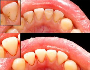 severe gum disease